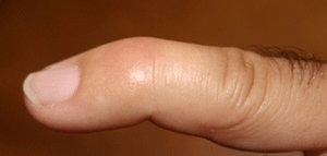 Mallet Finger Photo